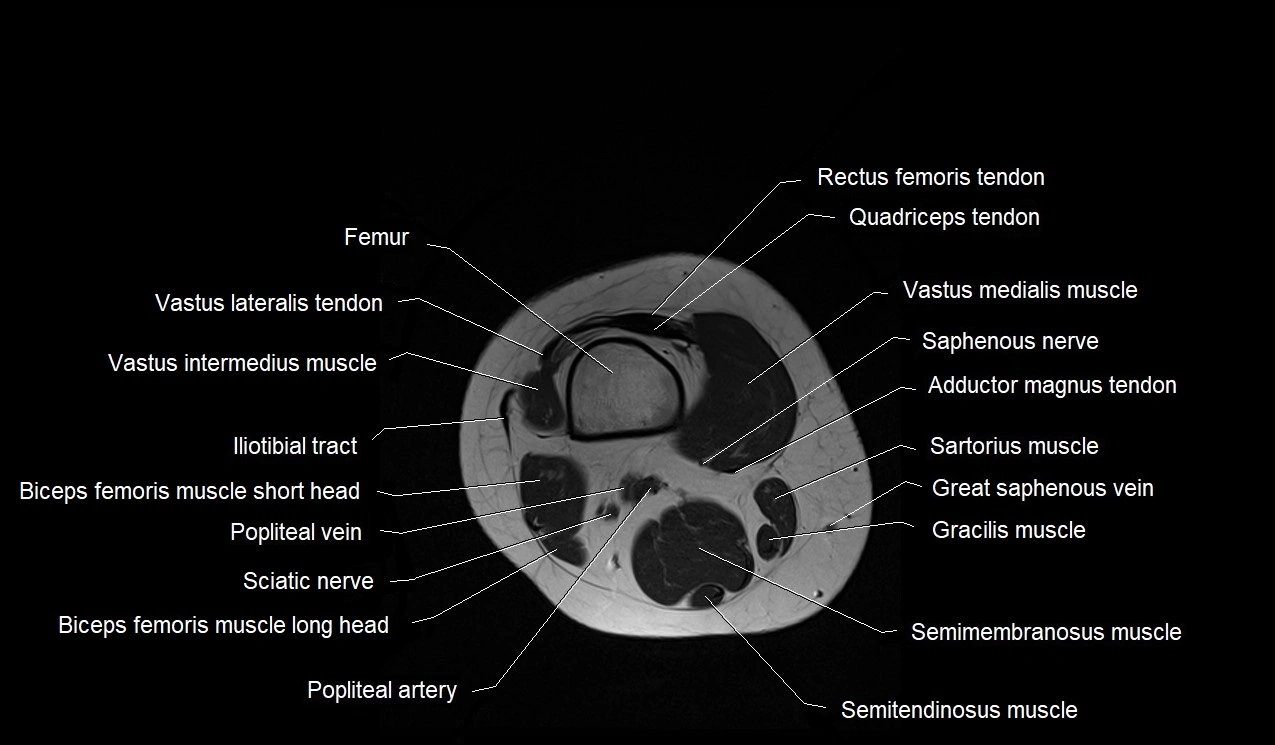 MRI thigh cross sectional anatomy image 50.webp